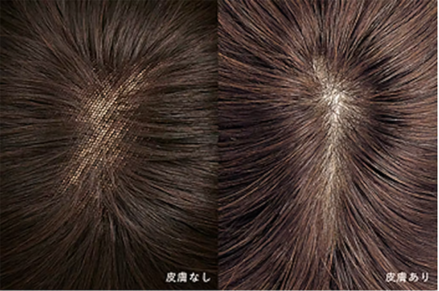 つむじ部分、皮膚なし・皮膚ありの画像