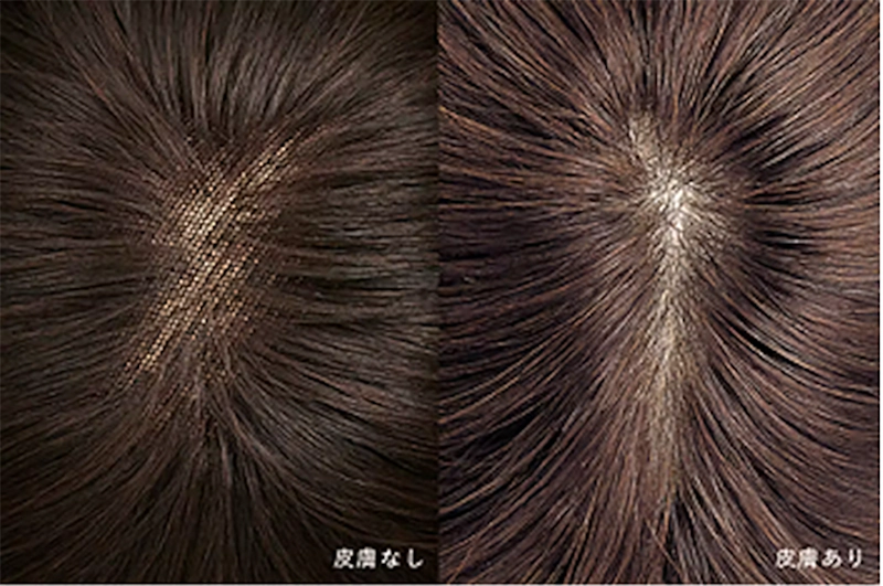 つむじ部分、皮膚なし・皮膚ありの画像