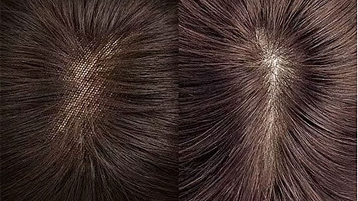 ウィッグのつむじ
皮膚あり・皮膚なしの比較